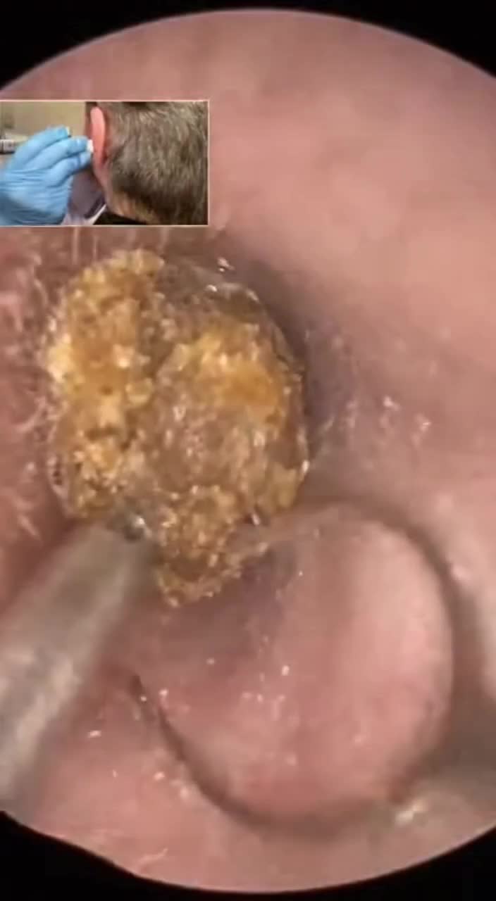 @Ear Cleaning