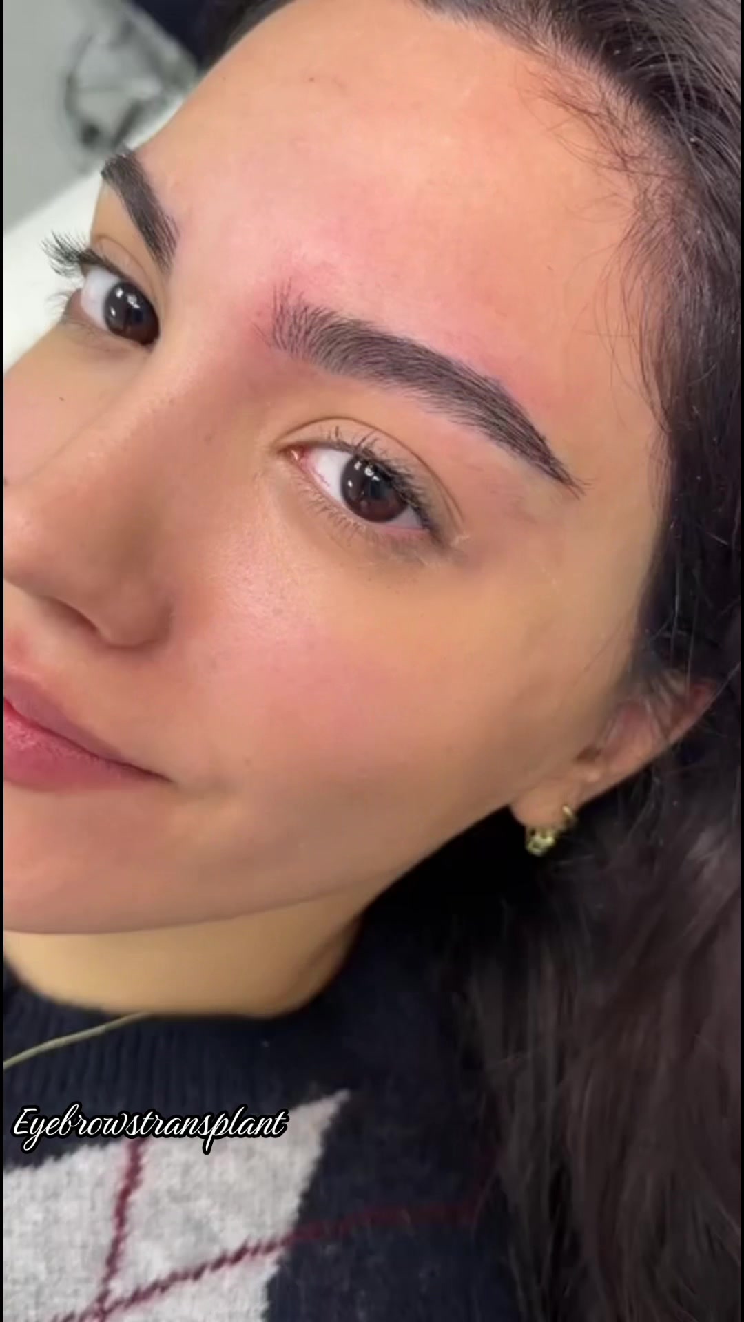 @Eyebrows Transplant