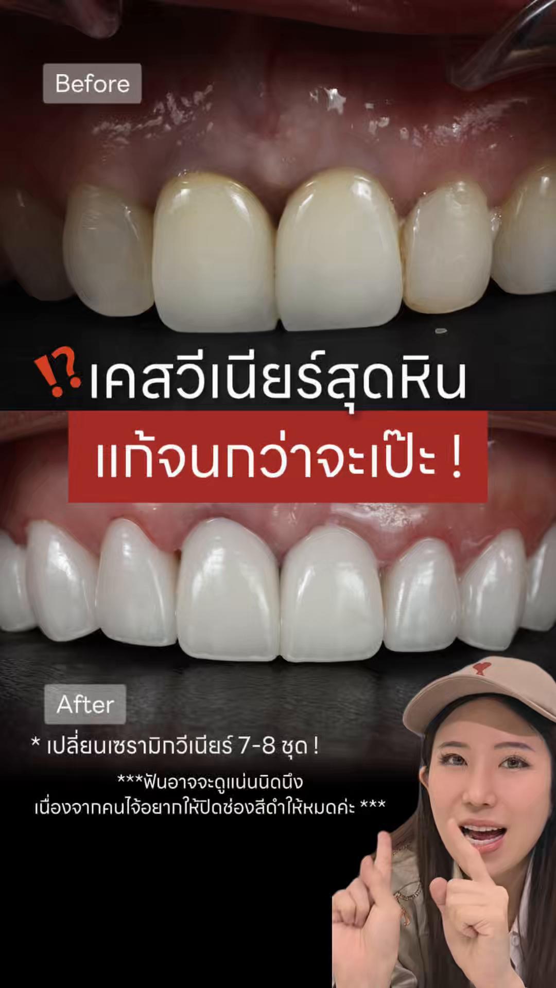 @หมอป่องสวยมาก veneer 🦷