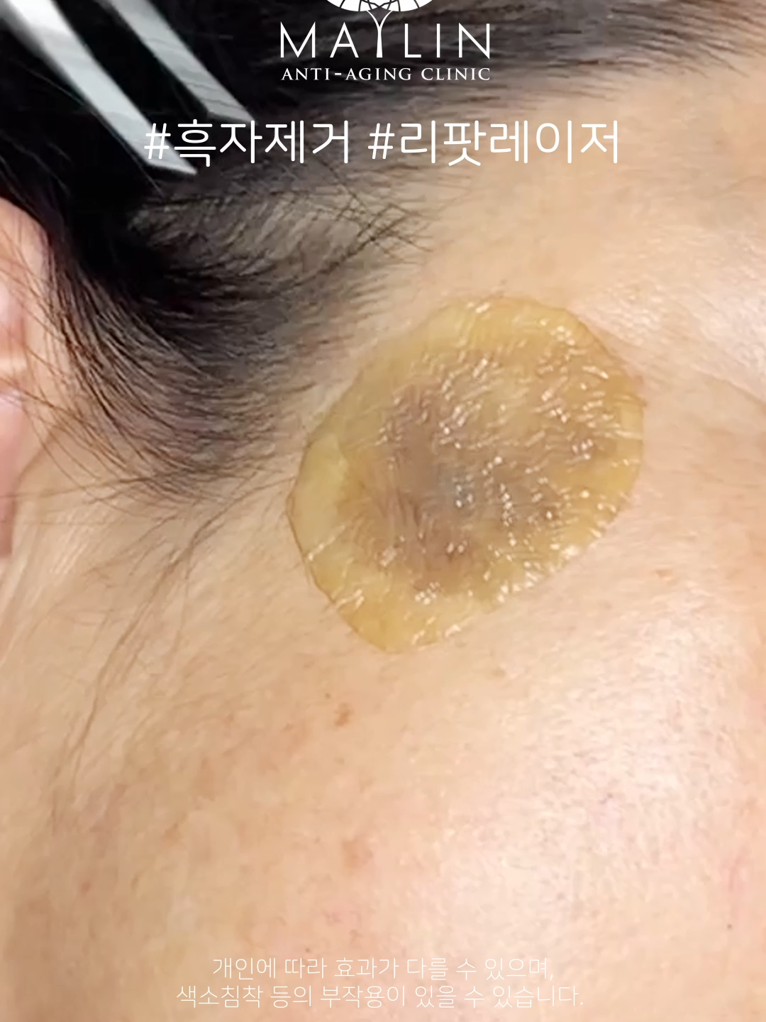 @메이린의원대구점