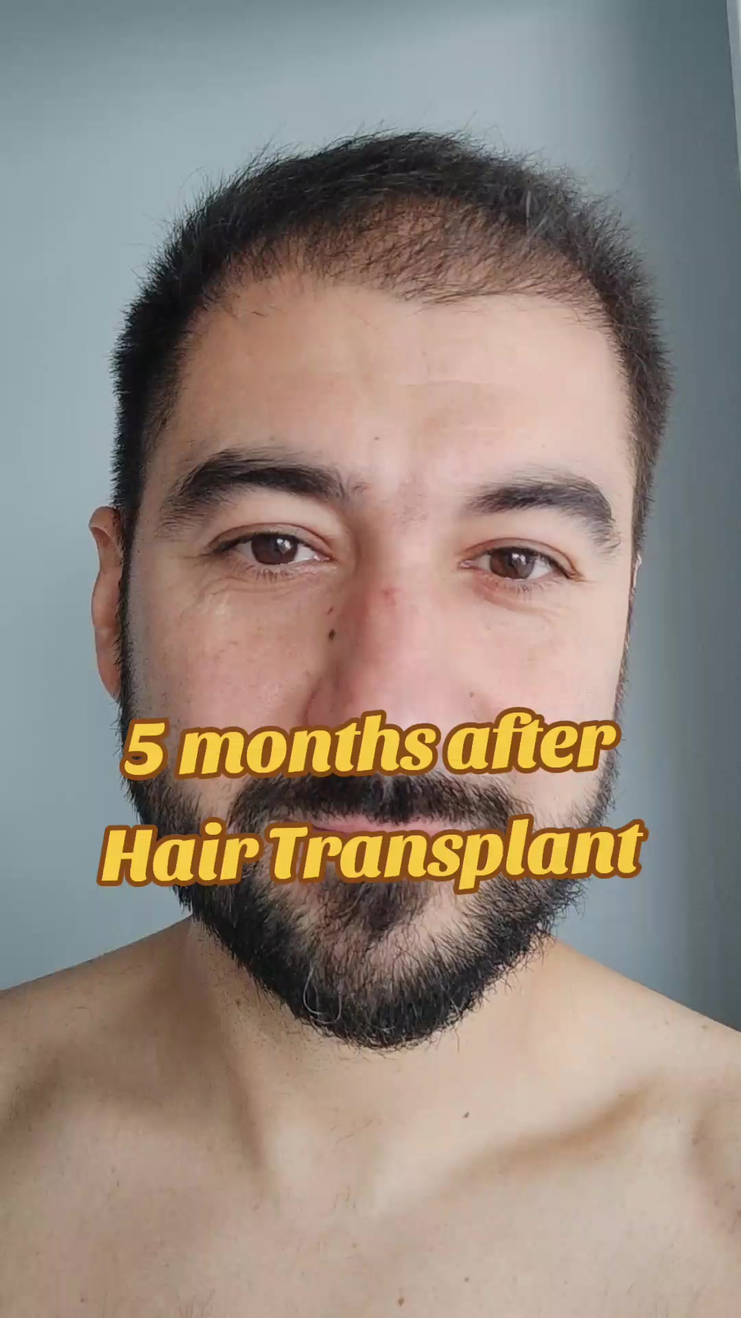 @My hair transplant