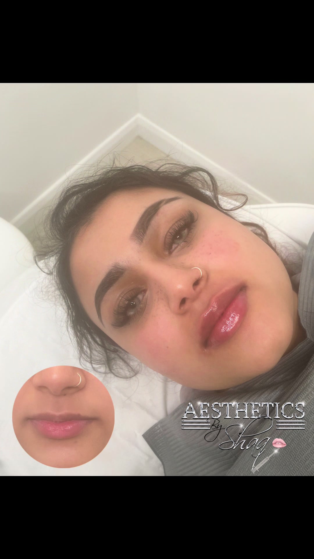 @Aestheticsbyshaq💉