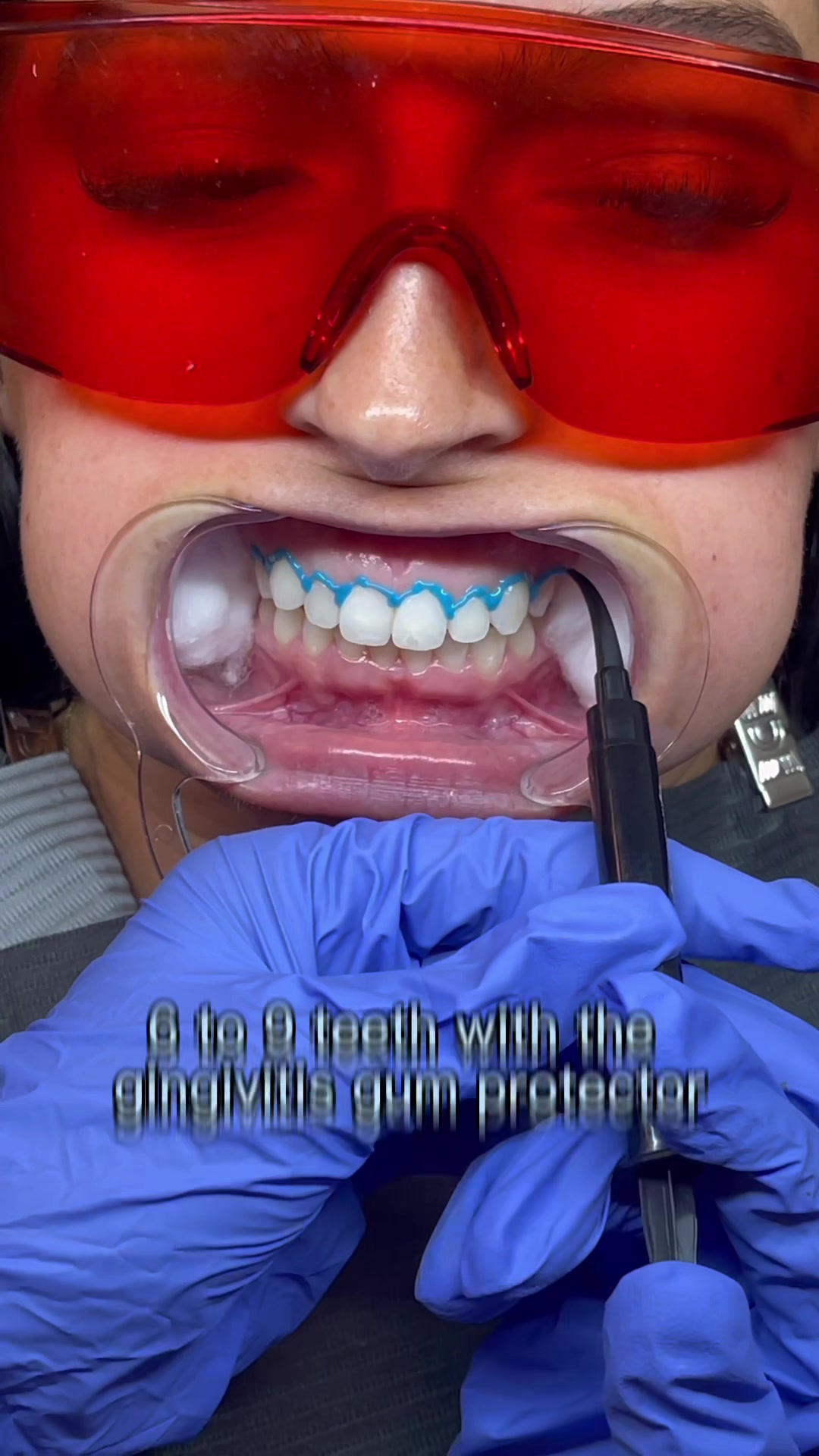 @Dian | Teeth Whitening Trainer