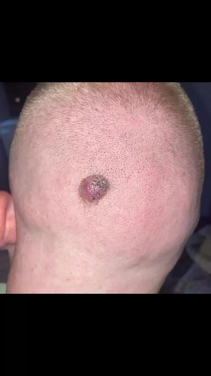 @Elliott CAN beat skin cancer