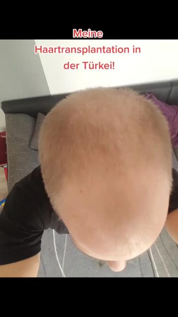 @Mr. Hairtransplant