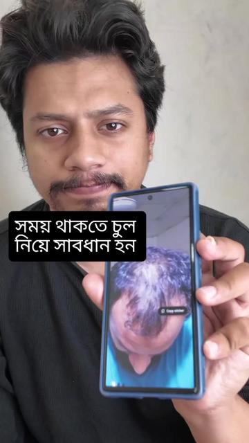 @NAZID HAIR TRANSPLANT
