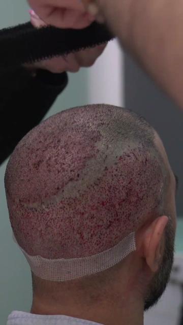 @Amit | Hair Transplant Tips