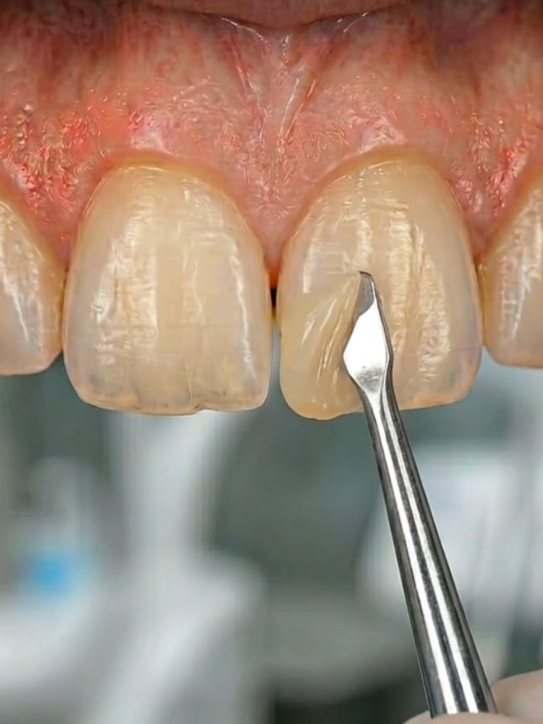 @Denti AI