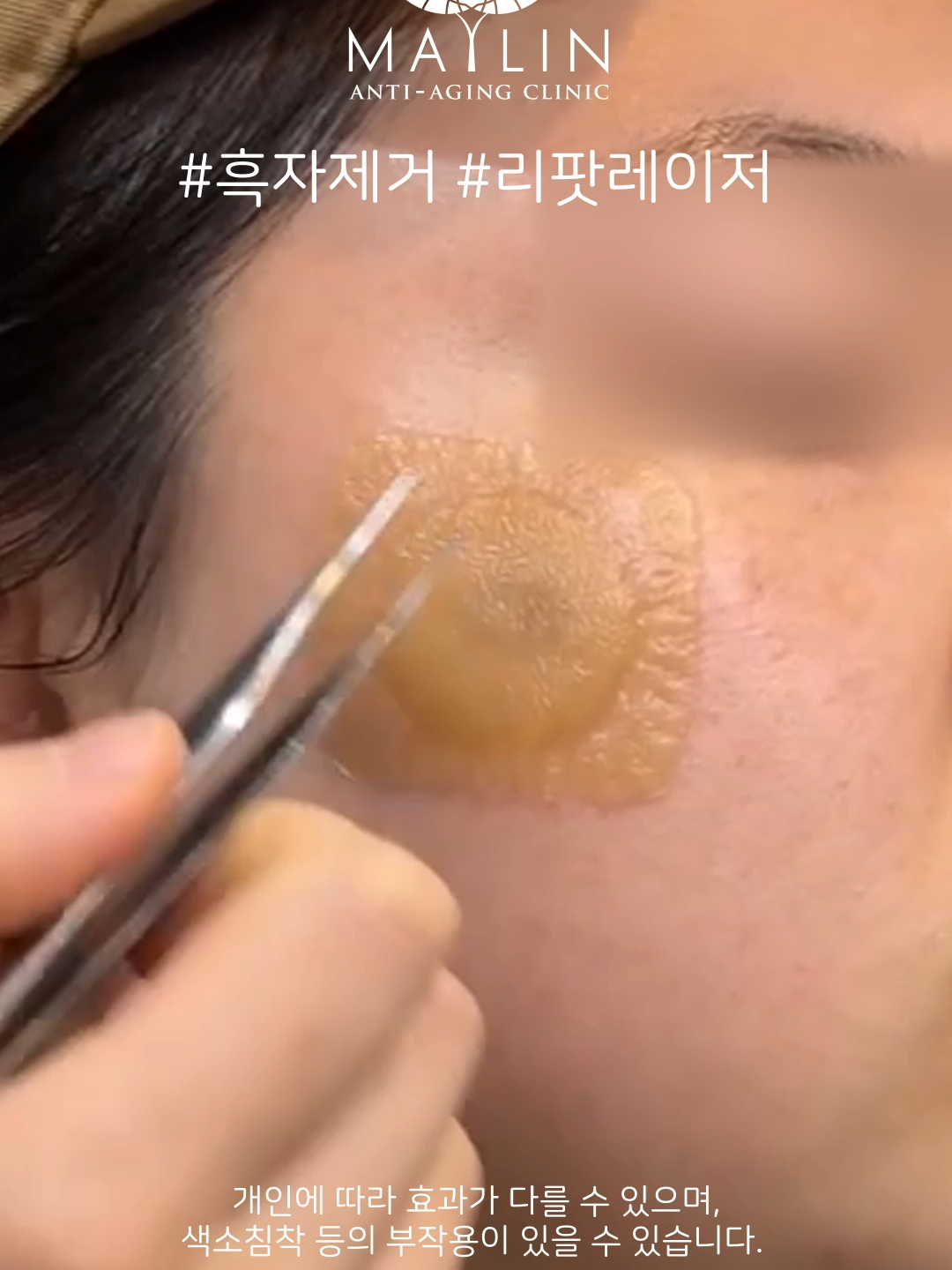 @메이린의원대구점