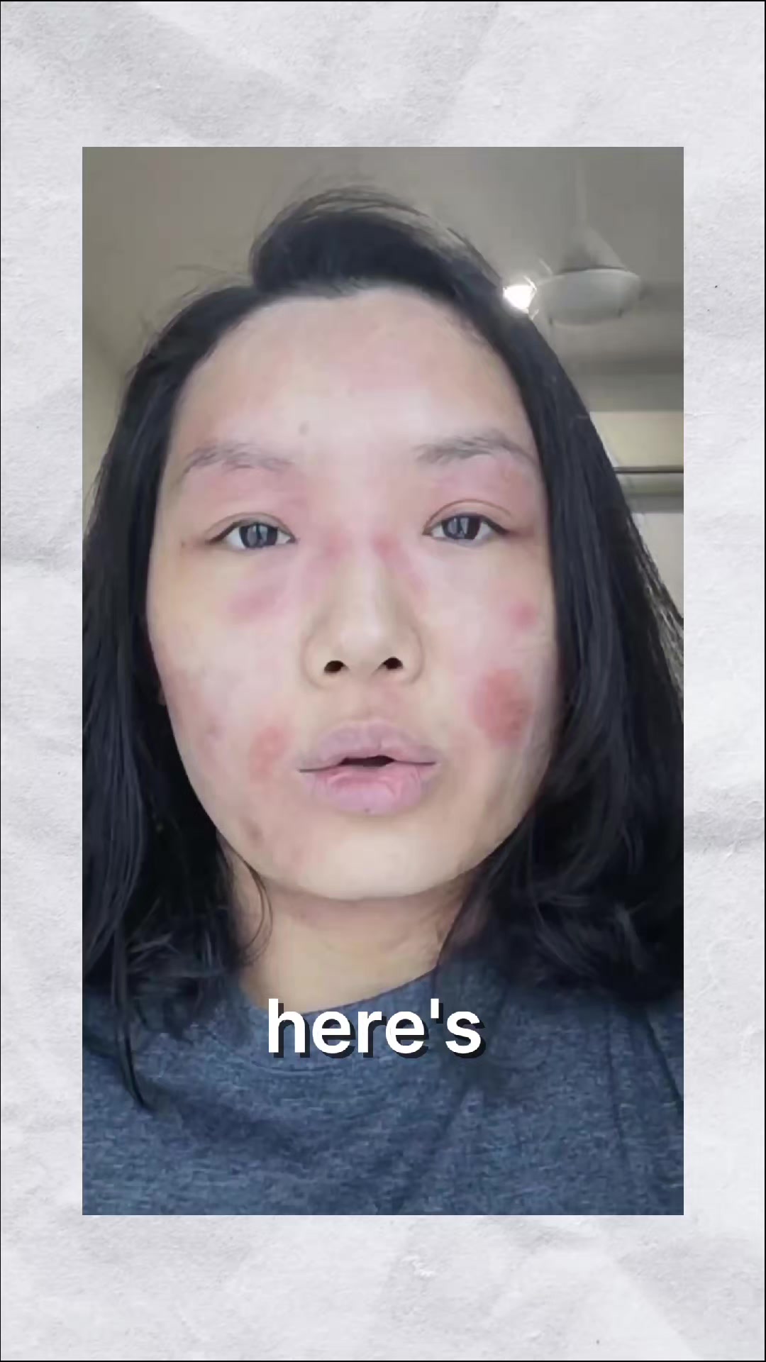 @Grace | TSW & Eczema Recovery