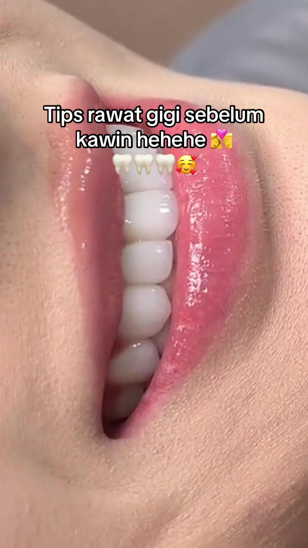@Gigi Putih Berkilau🦷✨
