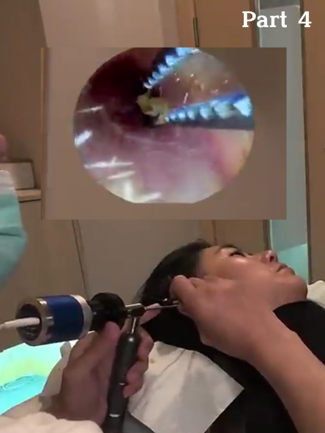 @ASMR Ear Cleaning