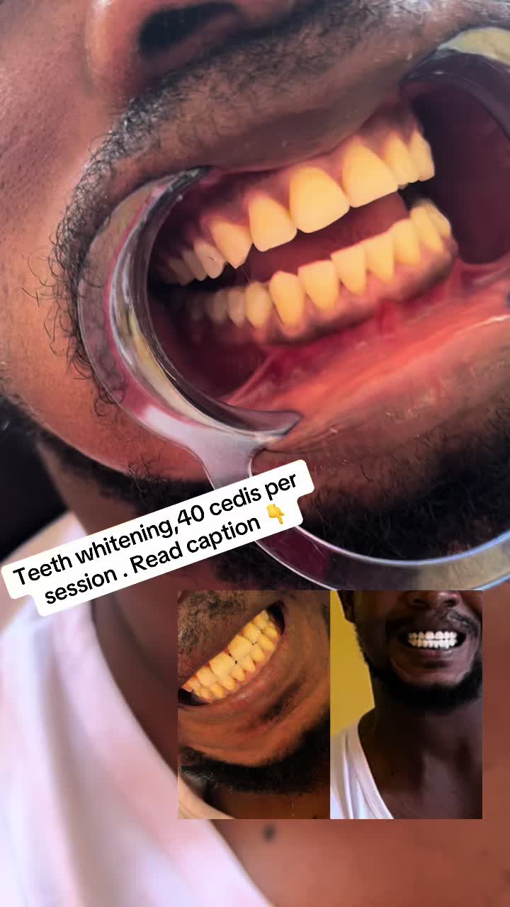 @Teethwhitening—MartGlow Avenue
