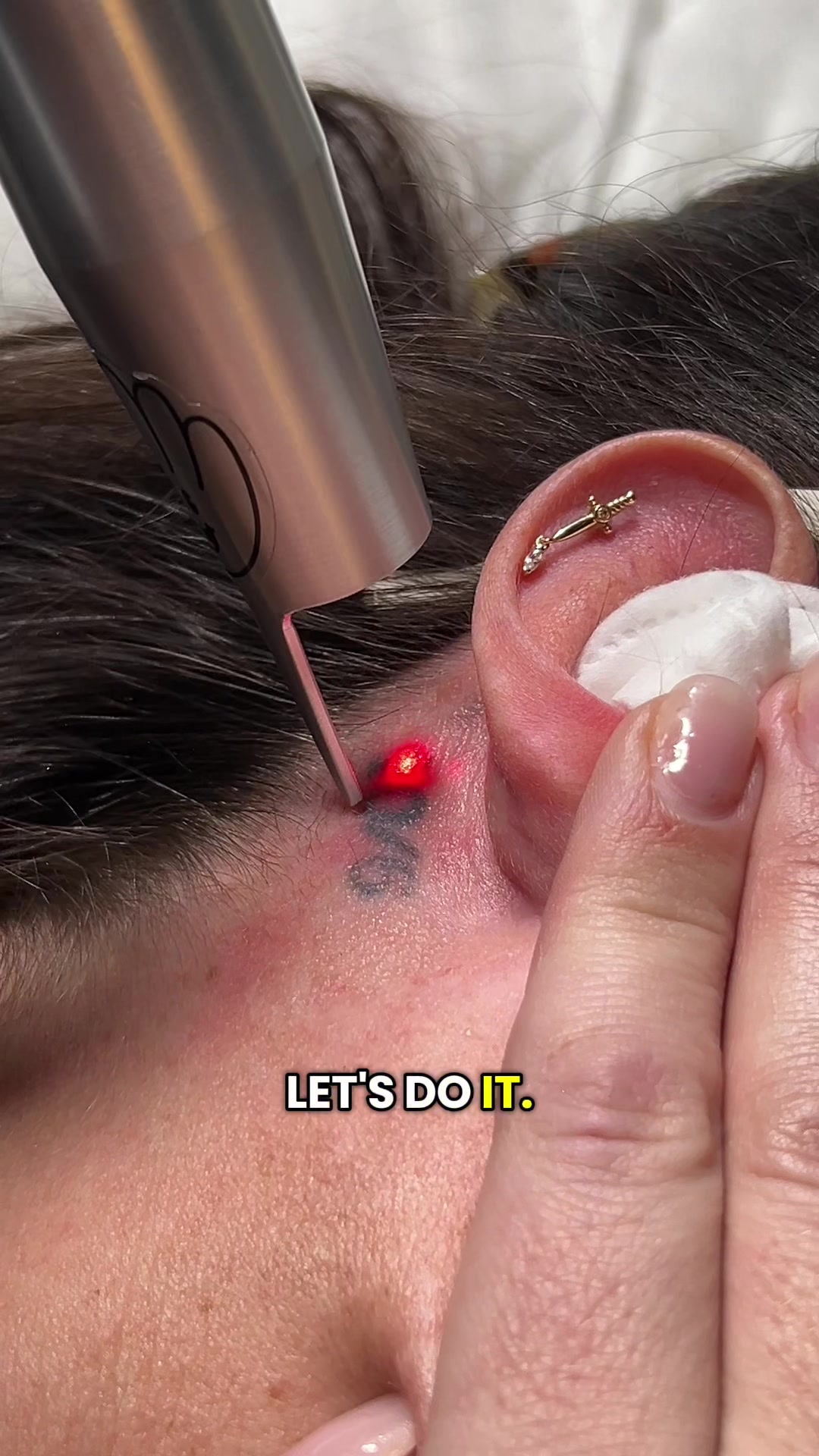 @Swift_tattoo_removal