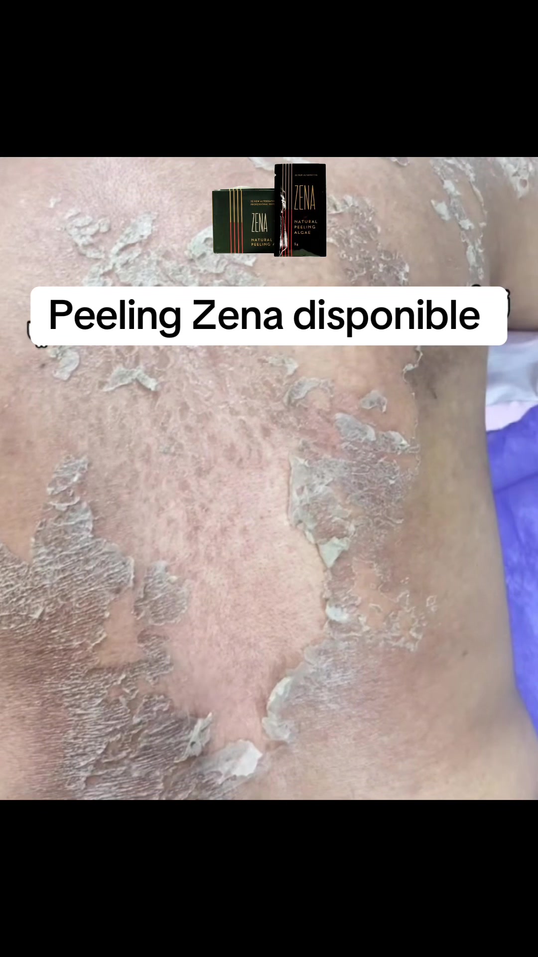 @peeling_zena