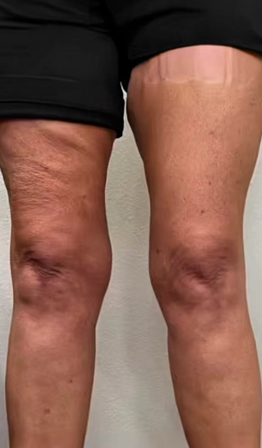 @Skinnies InstantLifts