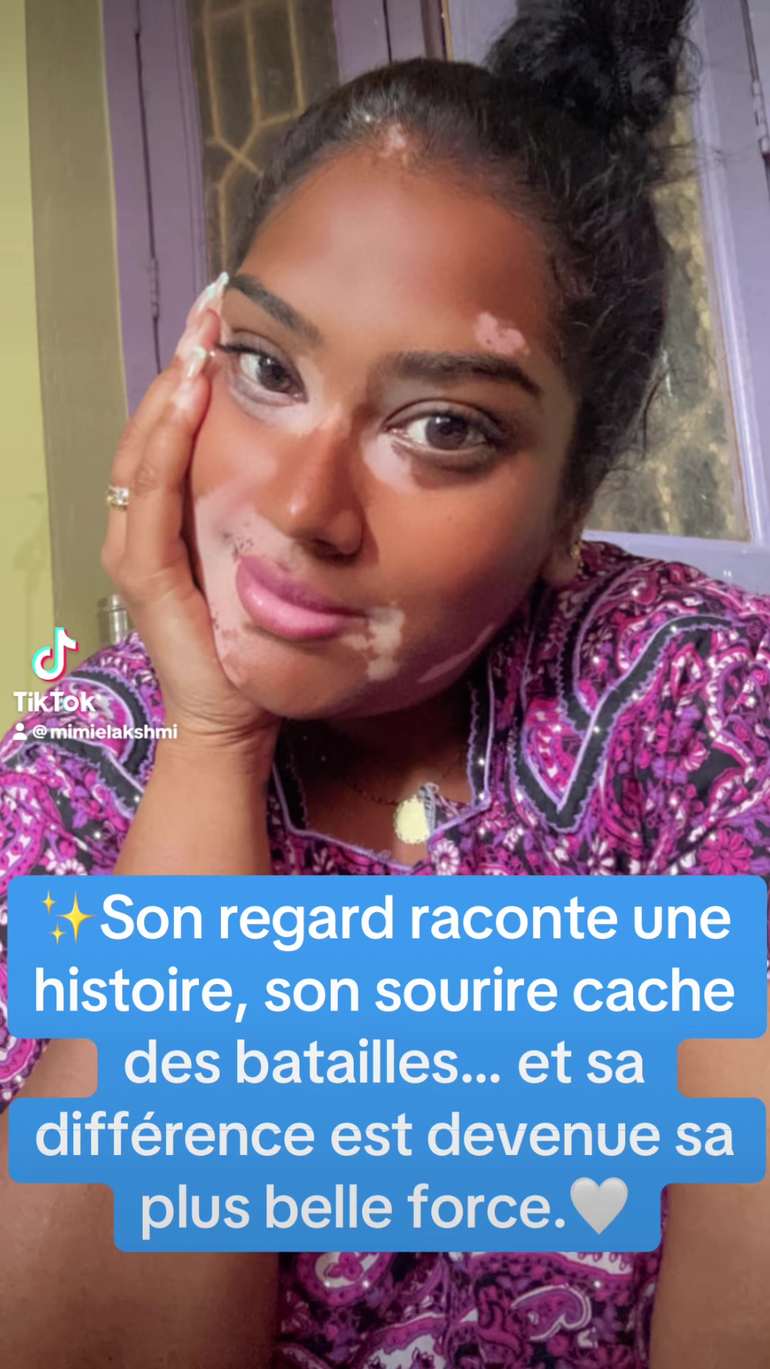 @Mimie | Vitiligo 🤍🌸