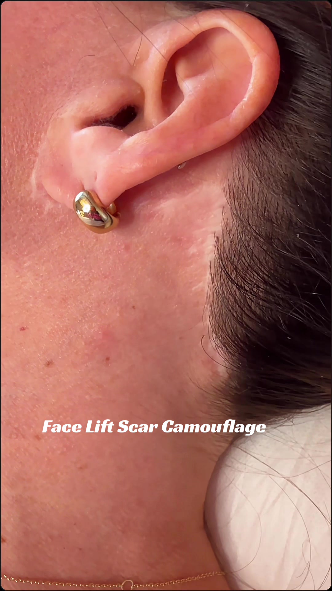 @Invisibleskinhelp
