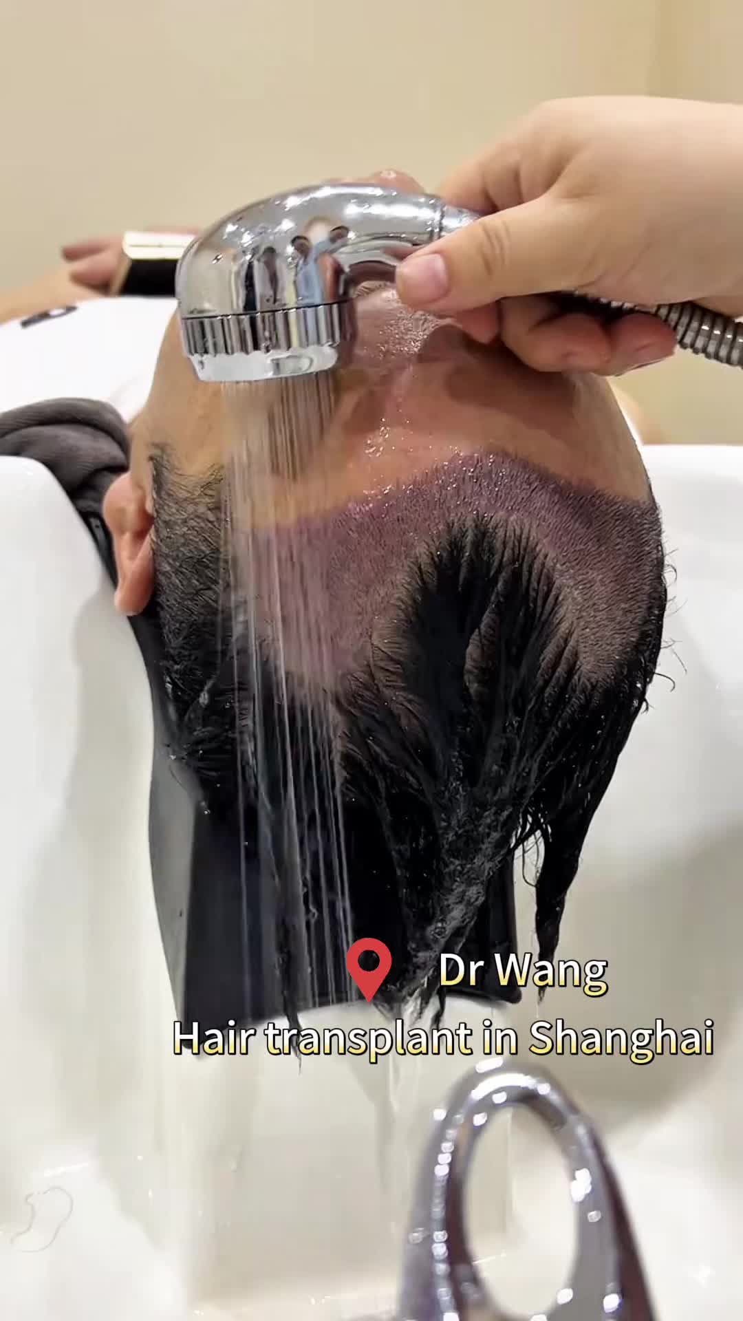 @HAIR TRANSPLANT WANG🇨🇳