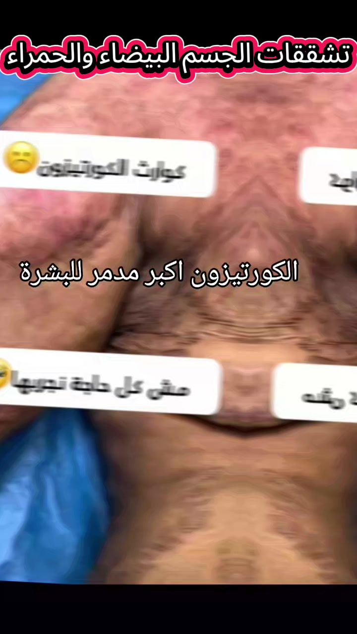 @drmanal " لعلاج التشققات "