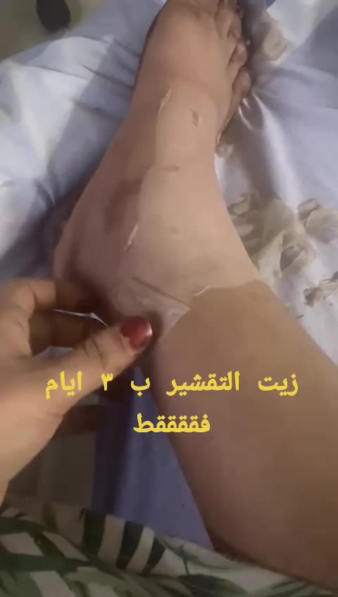 @drmanal " لعلاج التشققات "