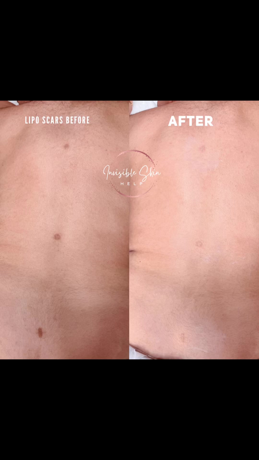 @Invisibleskinhelp