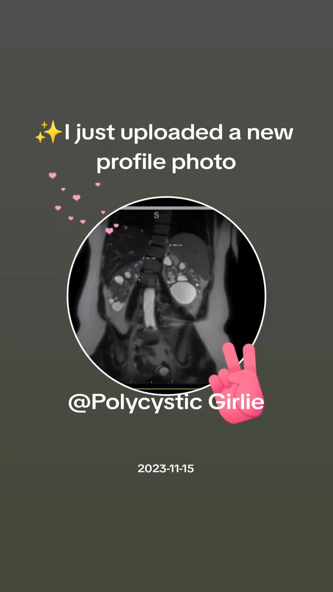 @Polycystic Girlie
