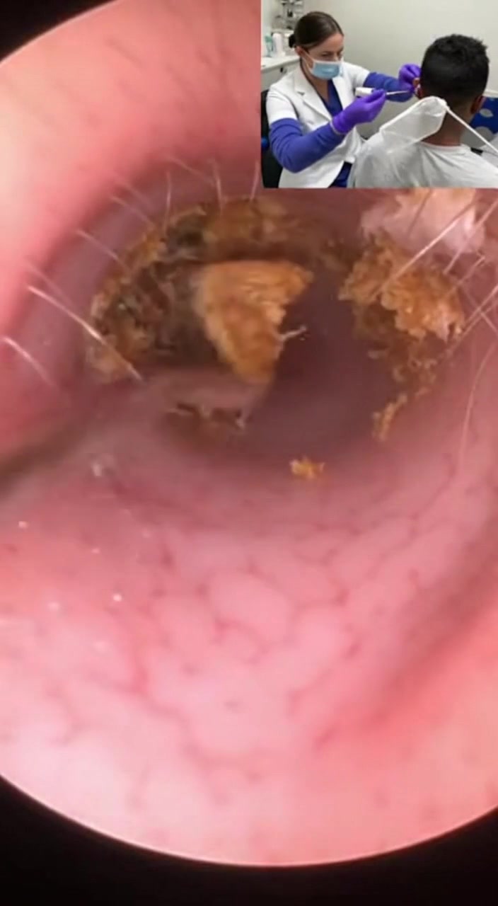 @Ear Cleaning