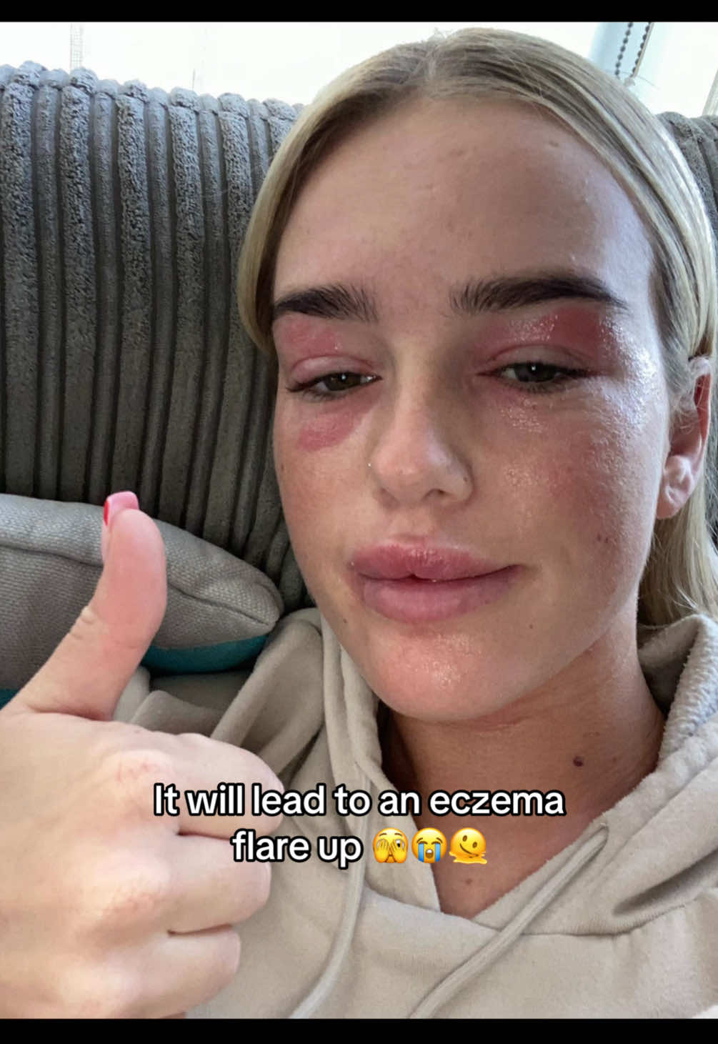 @Eczema Diaries USA & UK