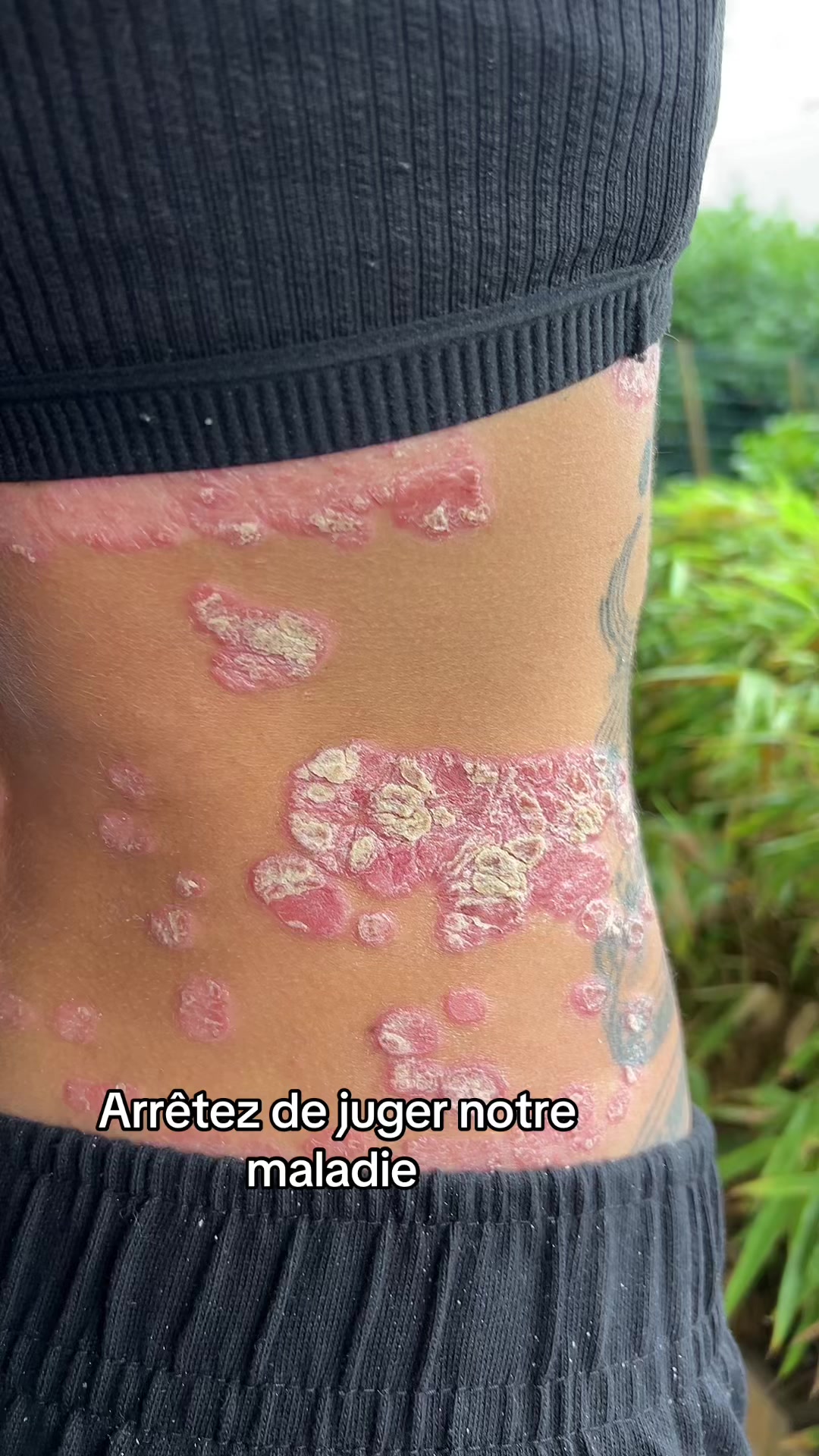 @lyla_psoriasistyle