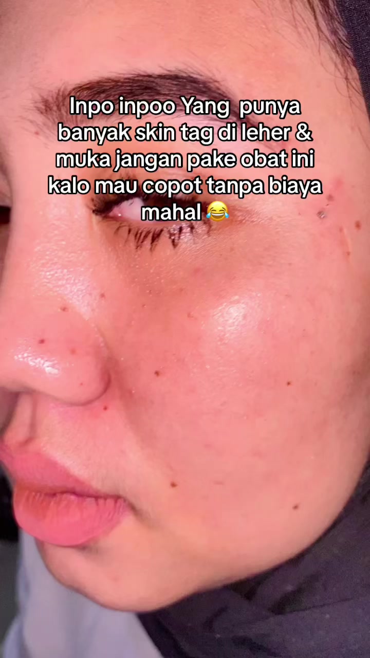 @Penghilangtahilalat.kaq.ay