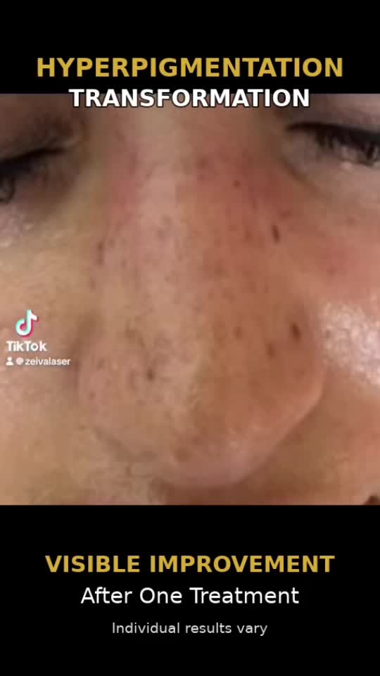 @Zeiva laser /Dearborn MI