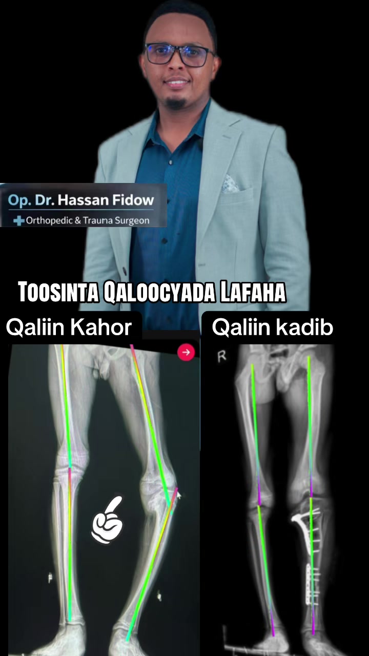 @DrHassan Fidow