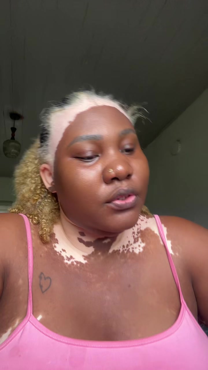@Thevitiligogirl