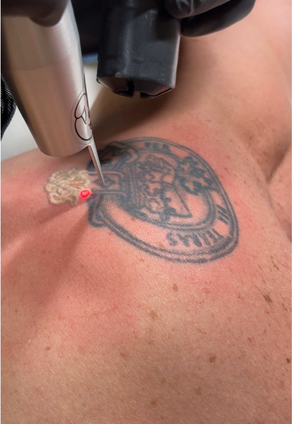 @Swift_tattoo_removal
