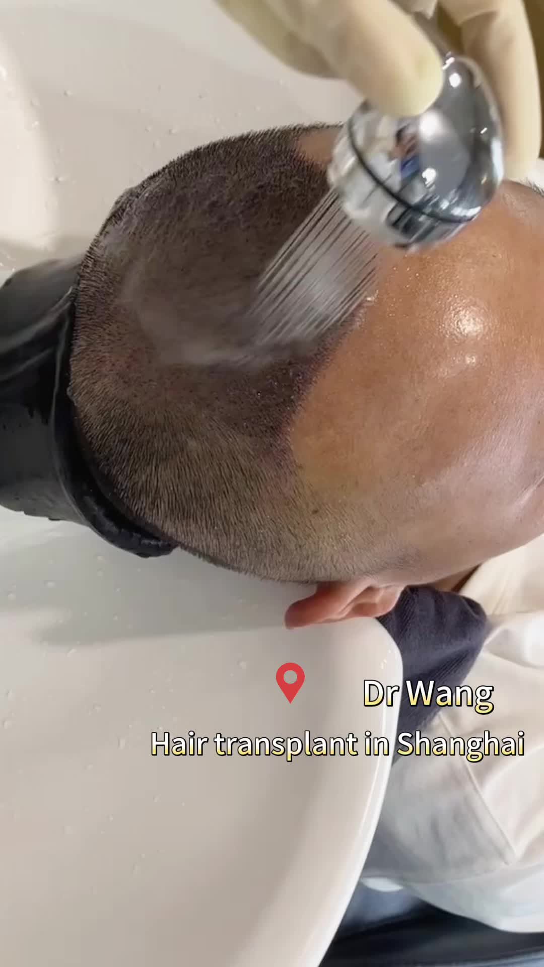 @HAIR TRANSPLANT WANG🇨🇳