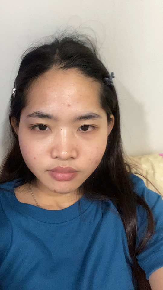 @acnefighter ew