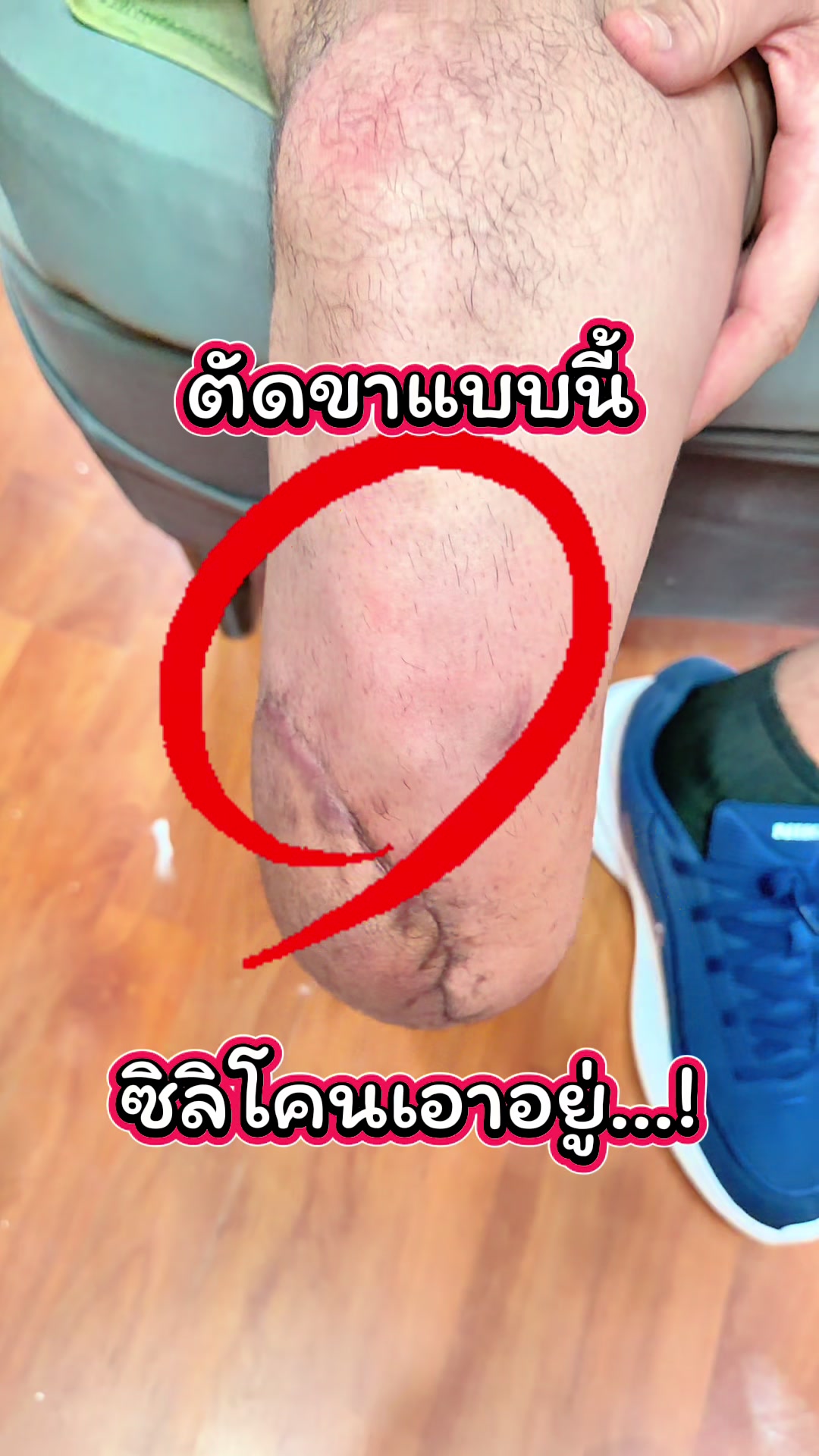 @คลินิกขาเทียม☎️089-6969502เอ็ม