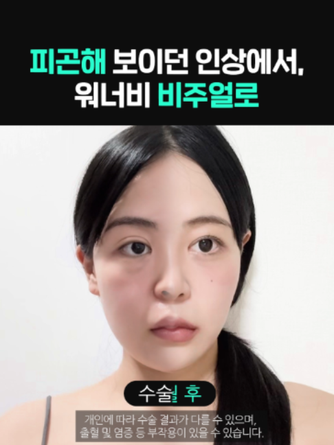 @디에이성형외과