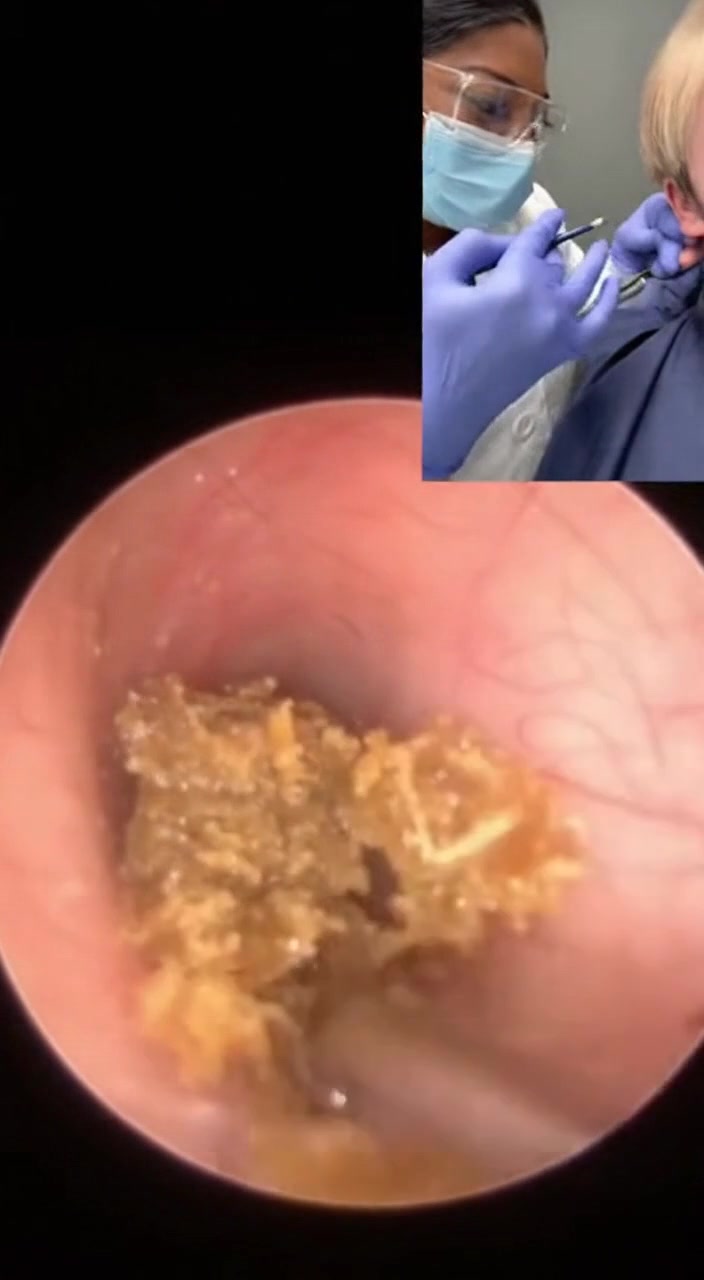 @Ear Cleaning