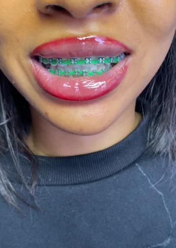 @Braces.bymavi|Smile Aesthetics