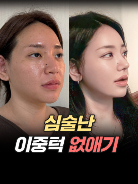 @디에이성형외과