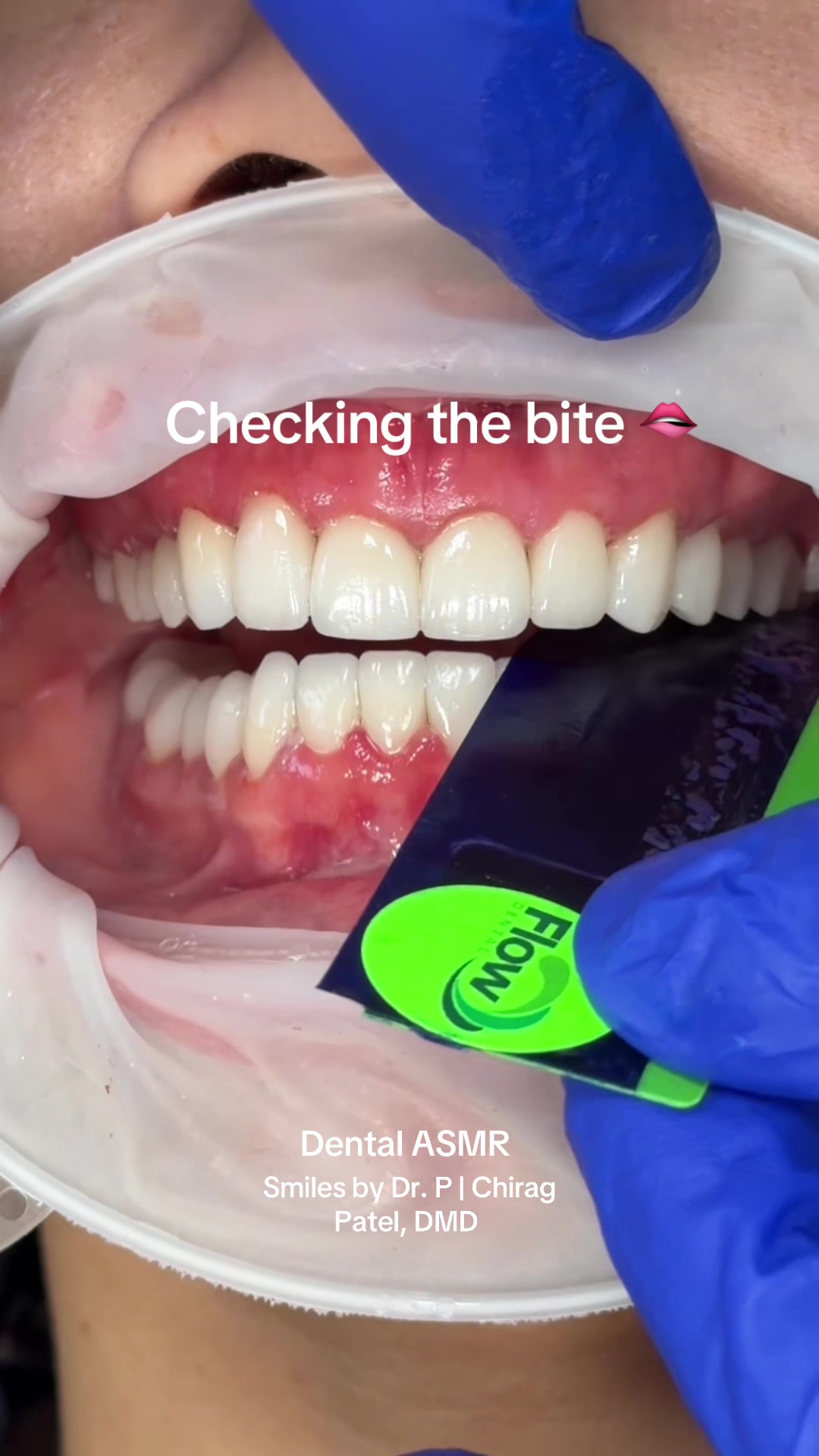 @Veneers