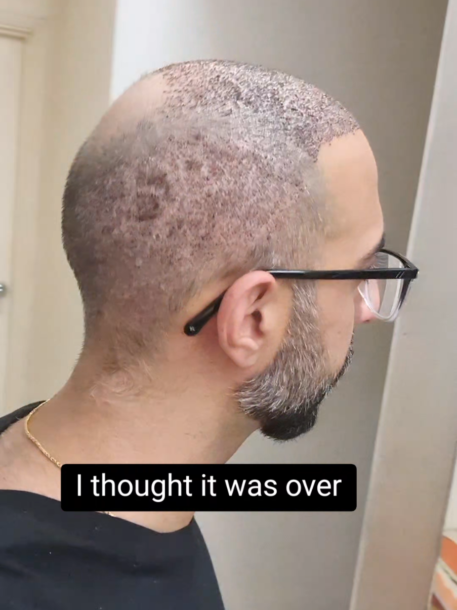 @Amit | Hair Transplant Tips