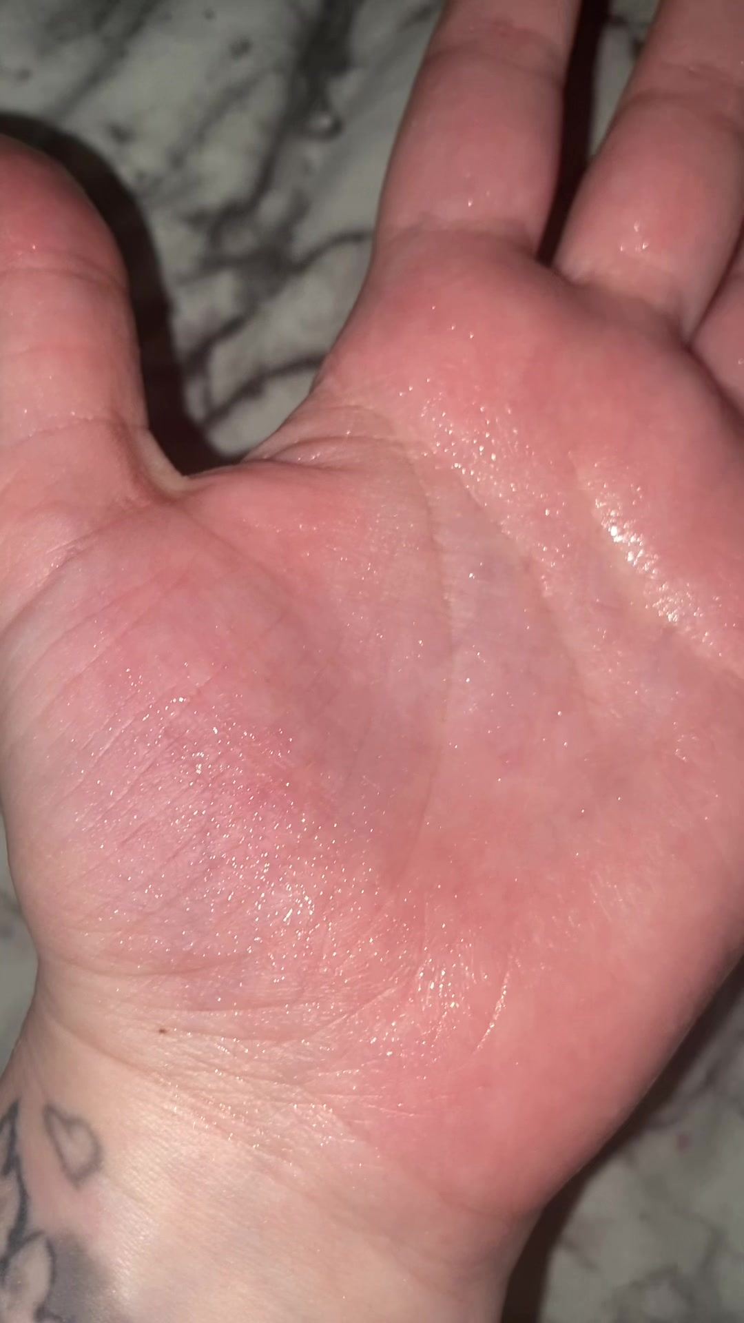 @LivingWithHyperhidrosis