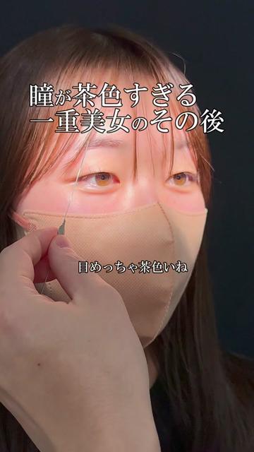 @りく先生　目元切開/クマ治療