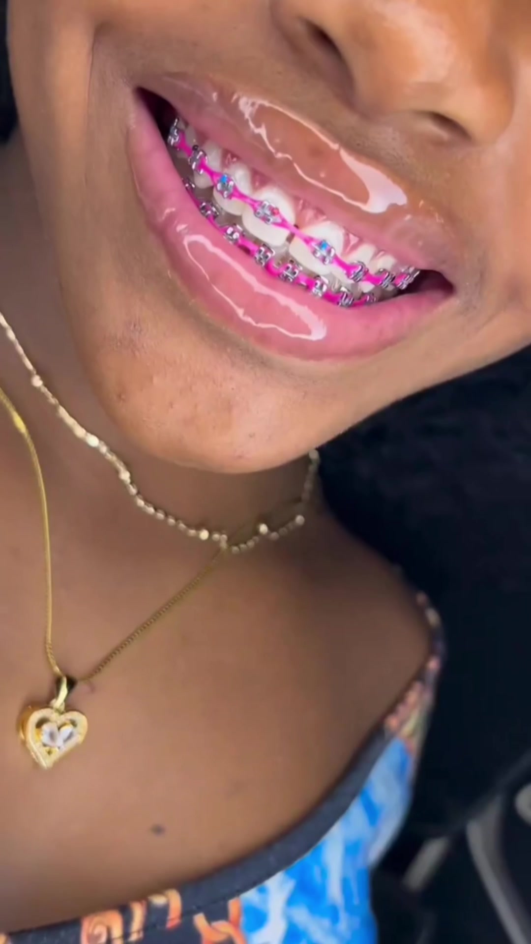 @MG BRACES
