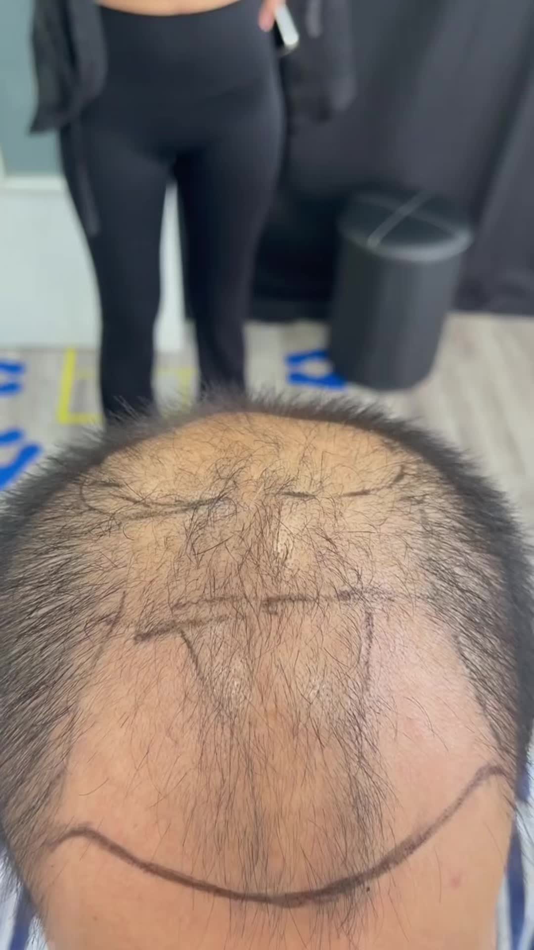 @HAIR TRANSPLANT WANG🇨🇳