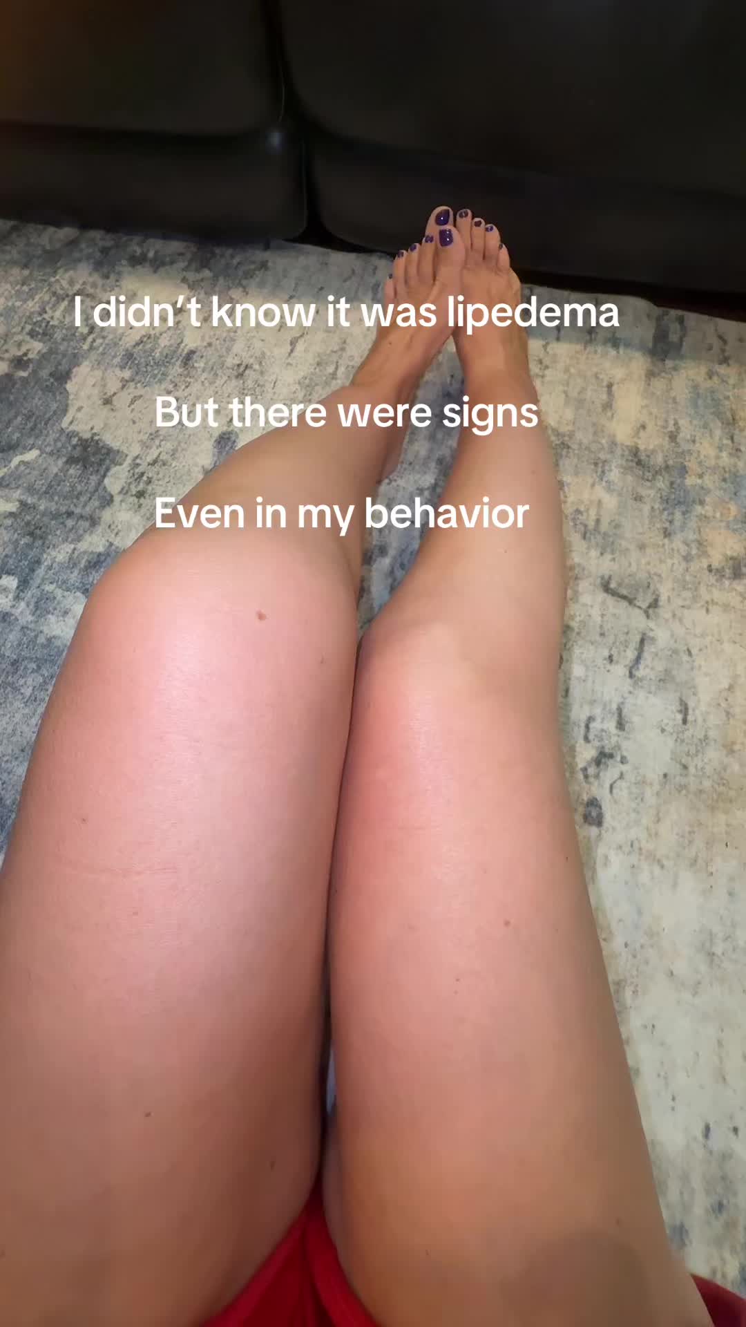 @Patty I Lipedema Lifestyle 💜