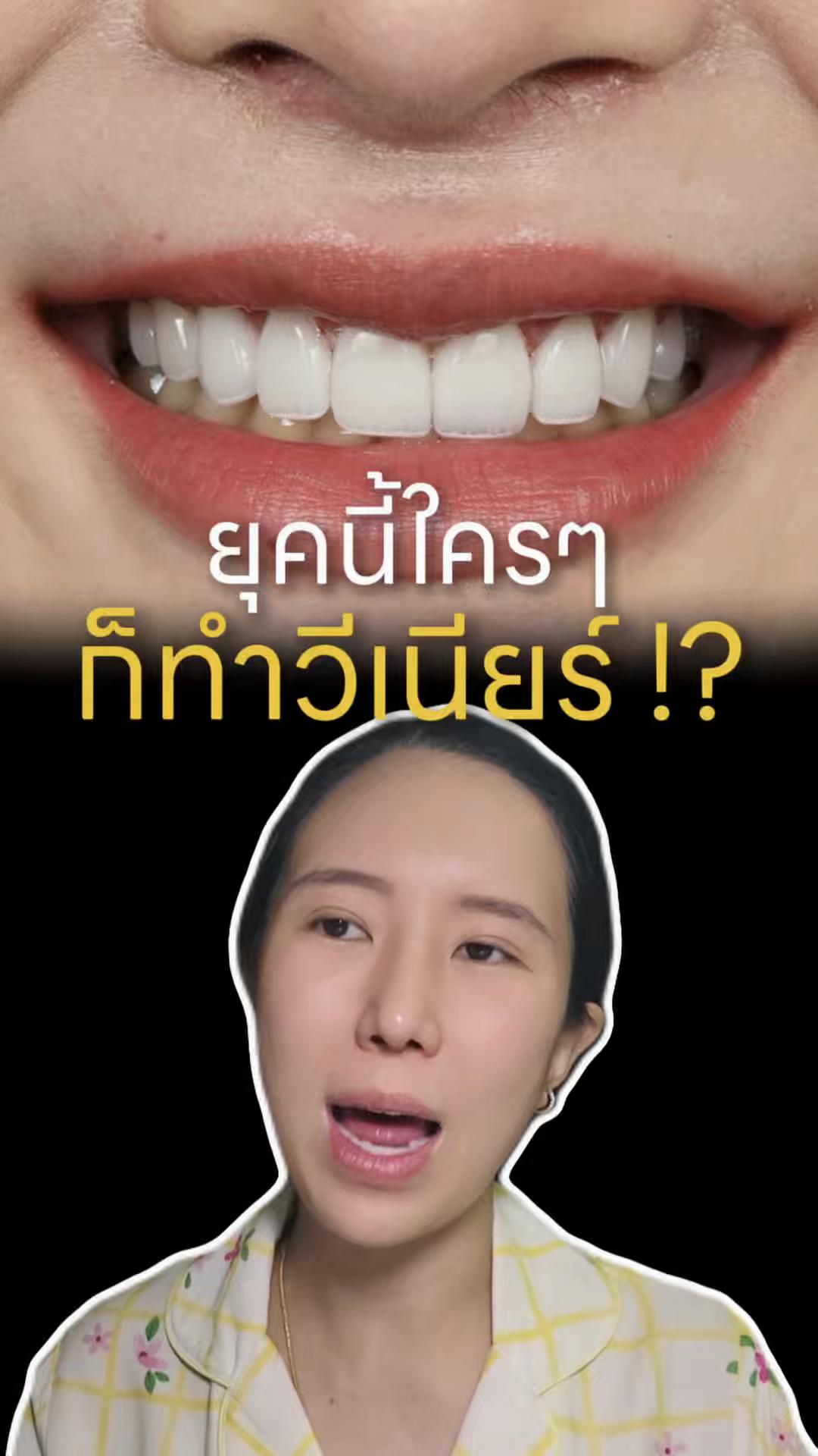 @หมอป่องสวยมาก veneer 🦷